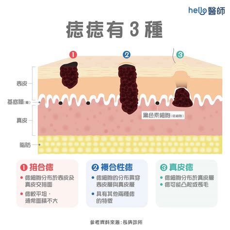 腹部長痣|痣變大、痣多或長毛會變皮膚癌？認識痣的形成與原因